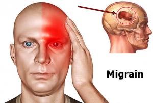 migrain-kepala-300x202.png
