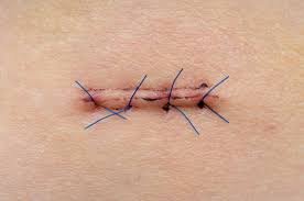 suture.jpg