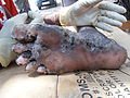 120px-Jigger_infested_foot_(2).jpg