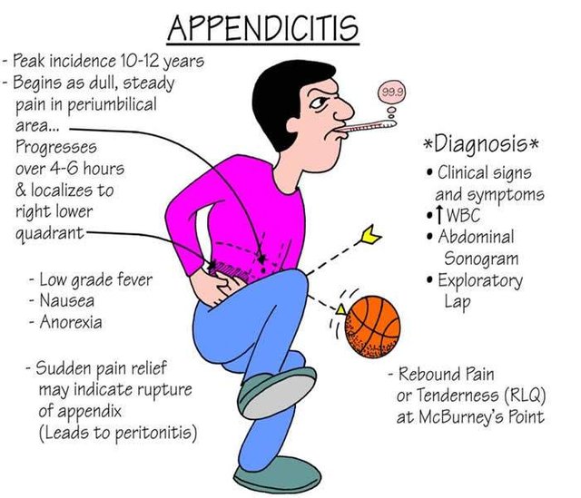 appendicitis.jpg