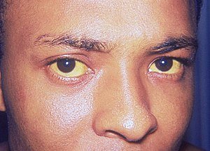 300px-Jaundice_eye.jpg