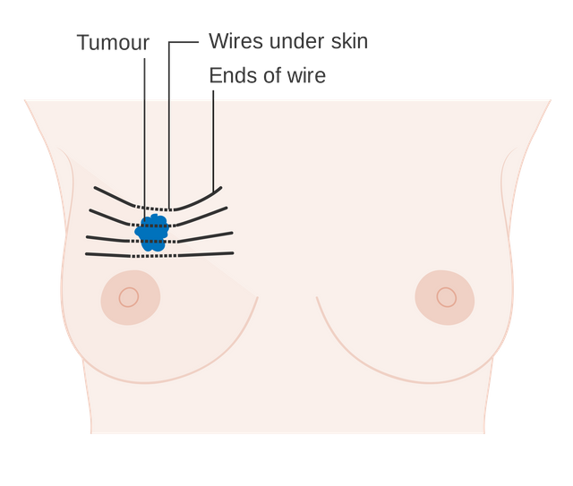 Diagram_showing_how_you_have_internal_radiotherapy_for_breast_cancer_CRUK_159.svg.png