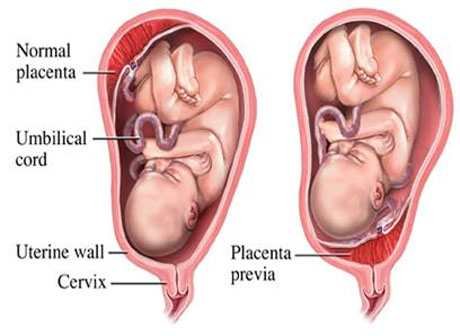 placenta_previa1.jpg