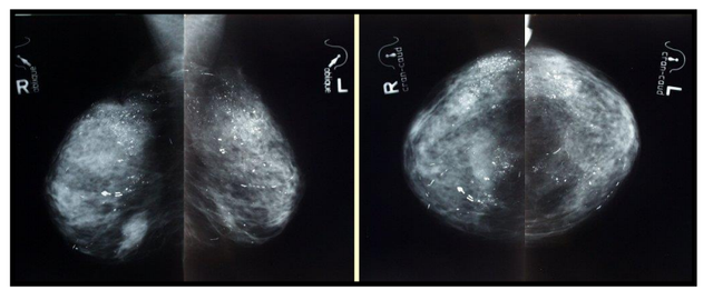 mamografia.png