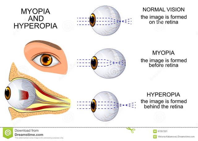 myopia-hyperopia-illustration-healthy-eye-eye-67357321.jpg