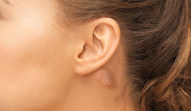 sebaceous cysts behind ear