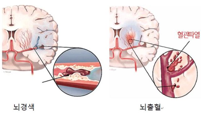 뇌2.JPG