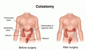 Colostomy1-300x176.png