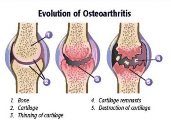 Osteoarthritis.jpg