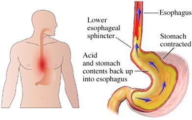 cause-of-acid-reflux-and-heartburn.jpg