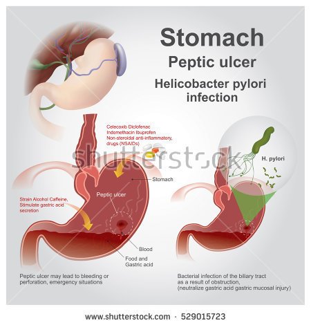 stock-vector-peptic-ulcer-disease-also-known-as-a-peptic-ulcer-is-a-break-in-the-lining-of-the-stomach-529015723.jpg