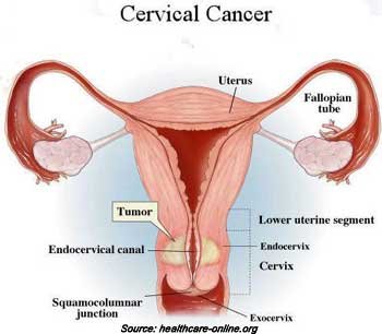 symptoms-of-cervical-cancer.jpg