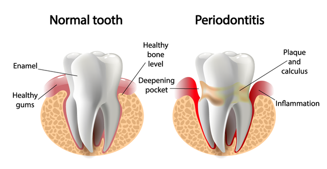periodontal.png