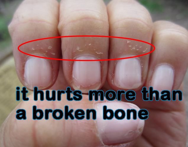 finger peeling cuticles.jpg