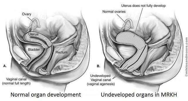 Groundbreaking-surgical-technique-gives-women-with-‘absent%u2019-vagina-syndrome-MRKH-born-again-womanhood.jpg