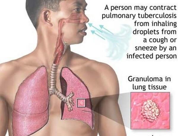 Pulmonary+tuberculosis+disease%281%29.jpg