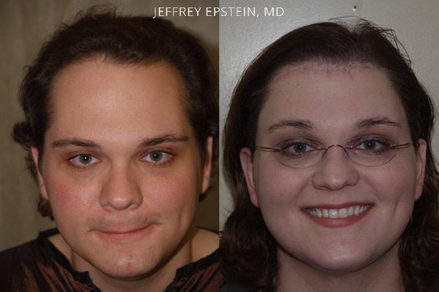 patient-41309-transgender-before-after-43.jpg