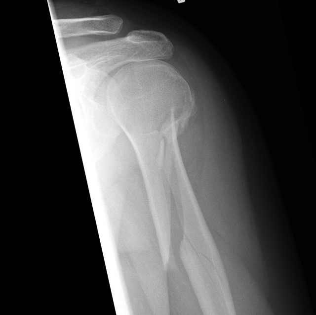 Humerus_spiral_fracture.png