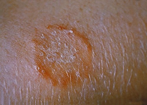 OSC_Microbio_05_01_ringworm.jpg