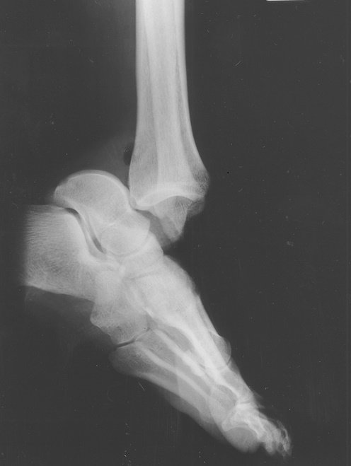 ankle dislocation.jpg