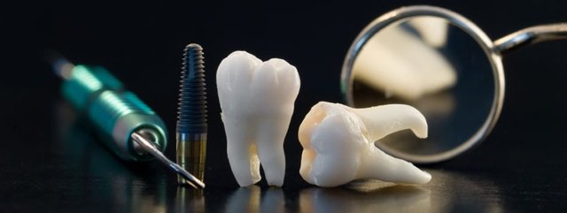 Dental Implants.jpg