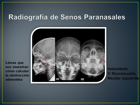 radiografía de adenoides