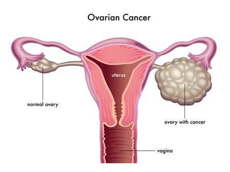 ovarian_cancer.jpg