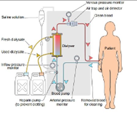 kidney dialysis attribution.jpg