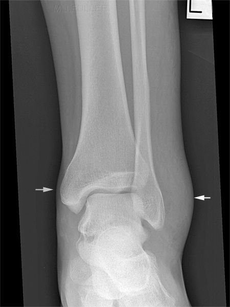 ankle swelling.jpg