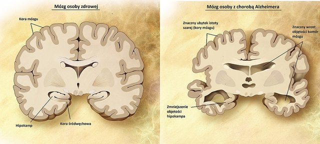1200px-ChAlzheimera-obraz-mózguPL.jpg