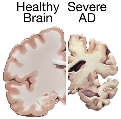 Alzheimers_brain.jpg
