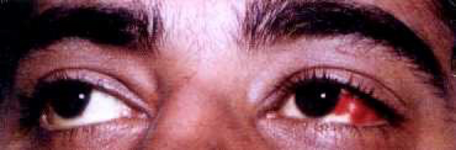 conjunctival hemorrhage.png