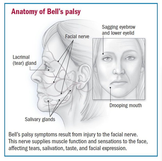 Bells-palsy.jpg