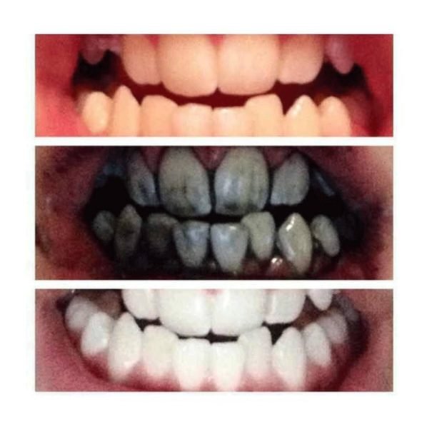 Acttivated-charcoal-used-on-teeth-Photo-Credit-Shopify-598x598.jpg