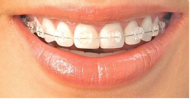 Orthodontic Brackets.jpg