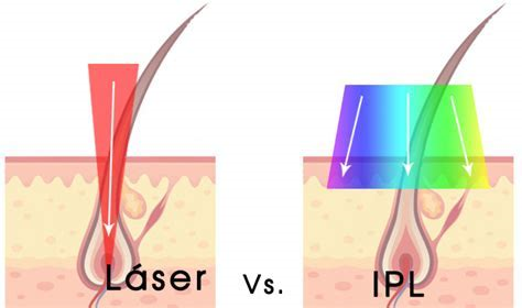 laser vs ipl.png