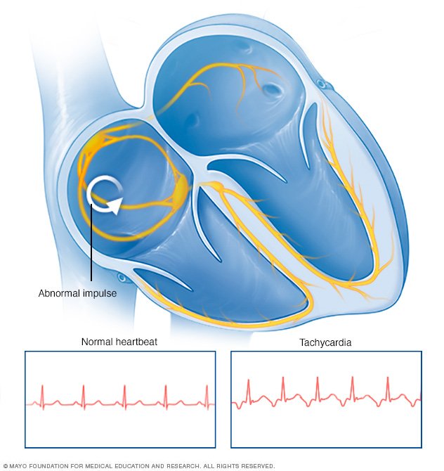 tachycardia-heartbeat-8col.jpg