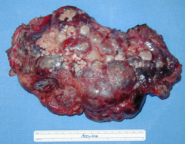 liver_cysts.jpg