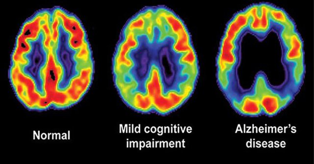 alzheimer-brain-scans.jpg