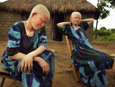 albinos-tanzania-4-1.jpg