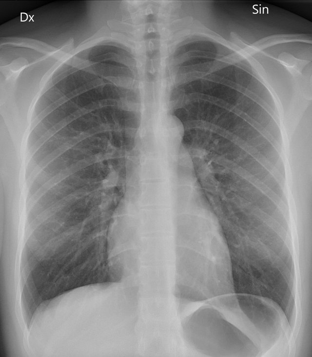 lung Normal posteroanterior_(PA)_chest_radiograph_(X-ray)Mikael Häggström CC0.jpg