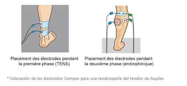 tendon2_050614.jpg