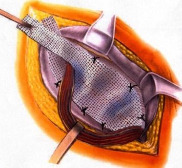 Lichtenstein Tension Free Hernia Repair.JPG