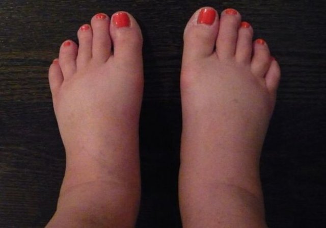 fat-feet-surgery.jpg