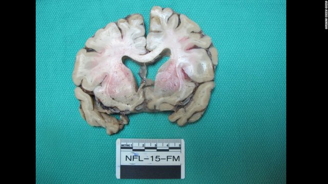 Scientists claim pathologist who studied Mike Webster's CTE brain is a  FRAUD and used healthy images