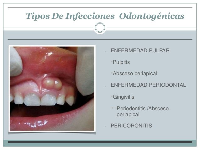 infecciones-odontogenicas-para-enviar-6-638.jpg