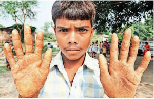 ballia_arsenic_poisoning-300x194.png