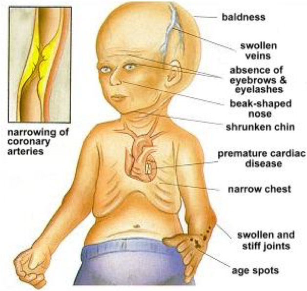 Symptoms_of_Progeria_5vTfmdu.max-1000x800.png