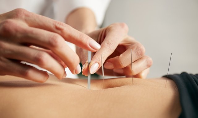 02_alternative_massage_techniques_you_need_to_try_acupuncture.jpg