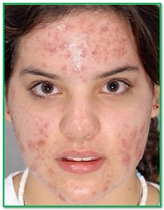 Acne-Pimples.jpg